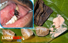 මෙරට මුඛ පිළිකා රෝගීන් සීග්‍රයෙන් ඉහලට